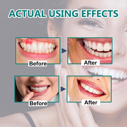 2pcs gum regrowth - 2pcs,