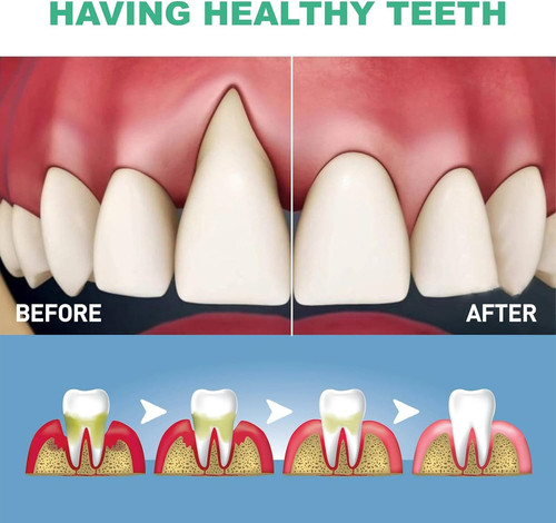 2pcs gum regrowth for - for, receding