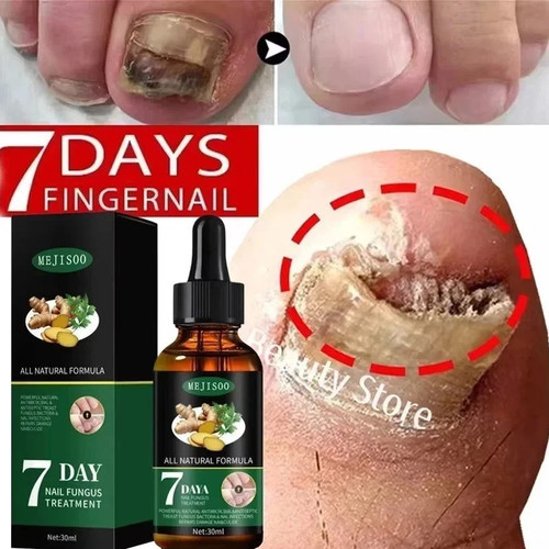 Fungal nail treatment - treatment, strong